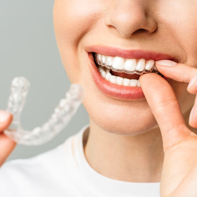 Alineación de dientes exceldent